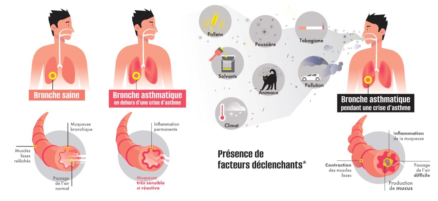 Schéma représentant la présence de facteurs déclenchants de l'asthme